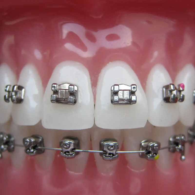 fixed-ortho-treatment
