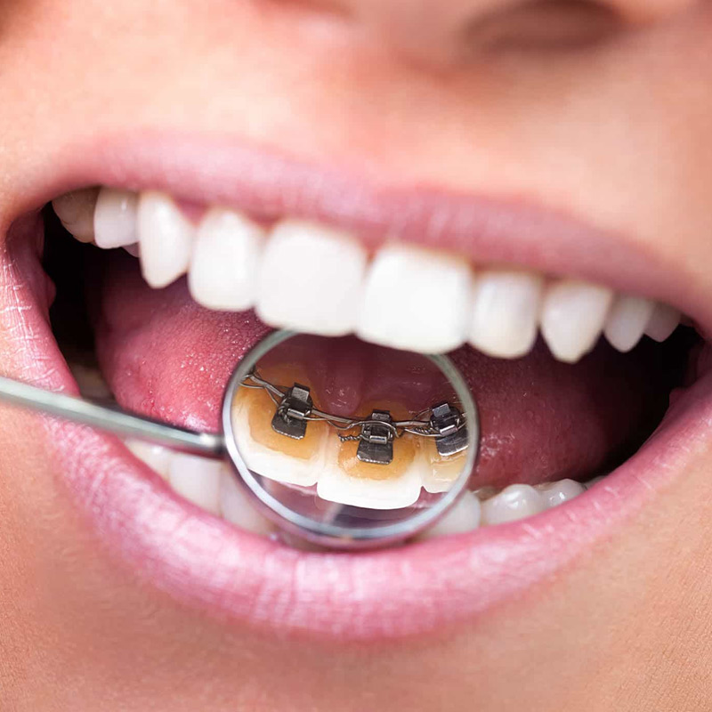 lingual-braces